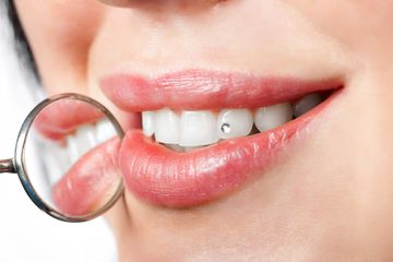 Happy Beauty Smile Crans-Montana dentiste dents blanches bijoux dentaires