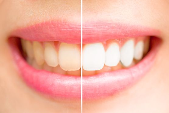 Happy Beauty Smile Crans-Montana dentist white teeth teeth whitening