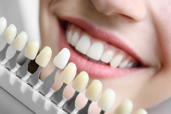 Happy Beauty Smile Crans-Montana dentist white teeth dental implants
